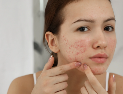 Acné: Evolución y Tratamiento